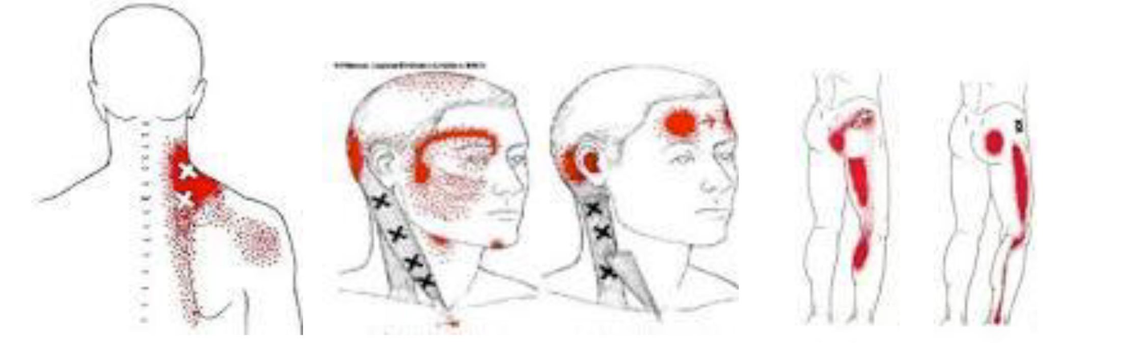 Polo Salute Lucca | Trigger points