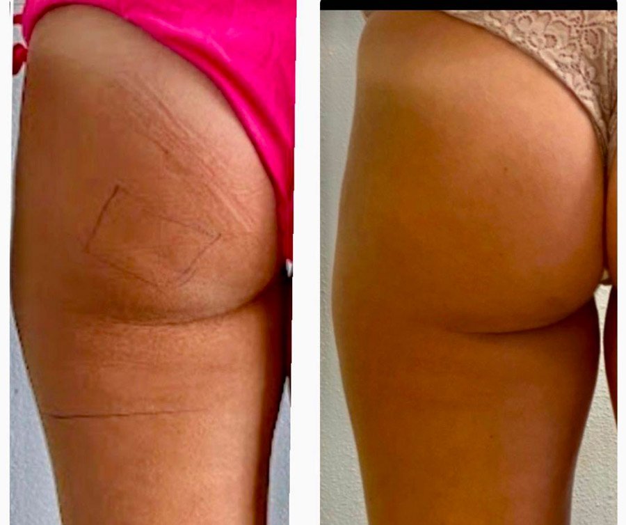 Polo Salute Lucca | PEFS: non solo cellulite