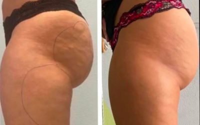 Polo Salute Lucca | PEFS: non solo cellulite