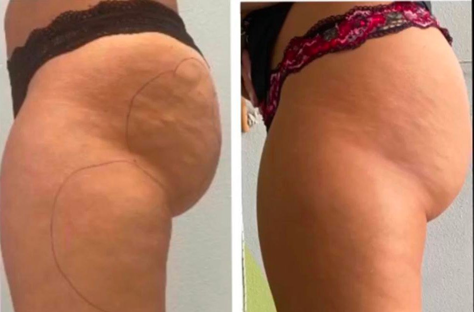 Polo Salute Lucca | PEFS: non solo cellulite